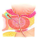 駐馬店民生醫(yī)院：前列腺增生的自我護(hù)理