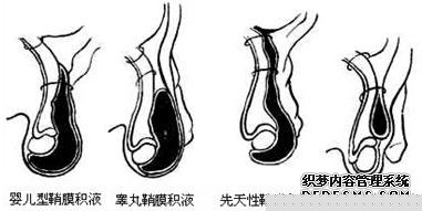 最新技術——腹腔鏡微創手術治療睪丸鞘膜積液
